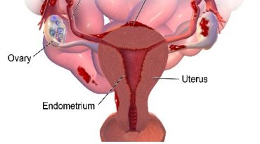 Endometriosis